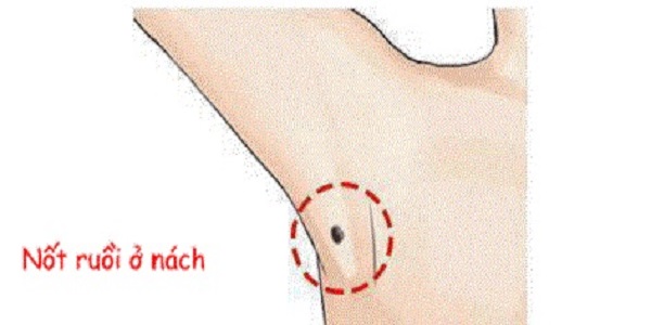 Nốt ruồi ở nách trái – phải nam, nữ nói lên điều gì?-4