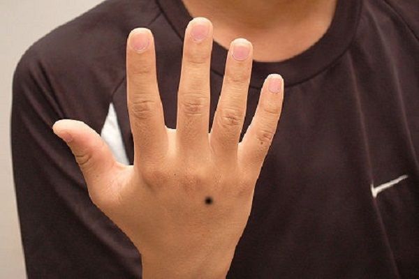 Nốt ruồi ở mu bàn tay trái - phải là hên hay xui?-3