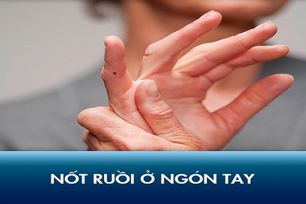 Nốt ruồi ở ngón tay út, cái, đeo nhẫn thì sao?-1
