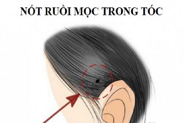 Nốt ruồi trong tóc đàn ông, phụ nữ là tốt hay xấu-1