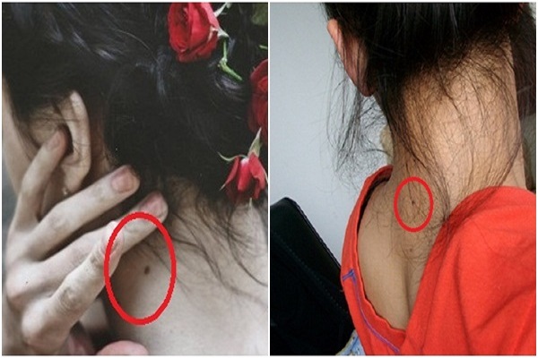 Nốt Ruồi Sau Gáy Đàn Ông, Phụ Nữ Nói Lên Điều Gì?-3