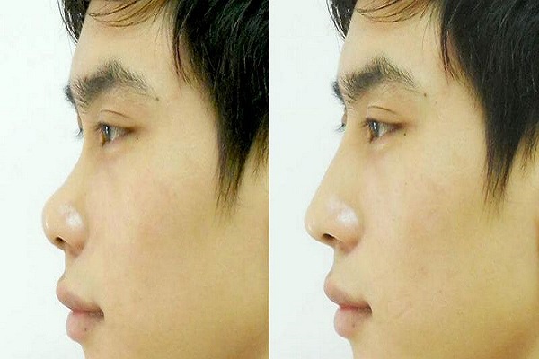 Mũi tẹt đẹp hay xấu? Xem tướng mũi tẹt đoán vận mệnh-2 Mũi tẹt đẹp hay xấu? Xem tướng mũi tẹt đoán vận mệnh-2