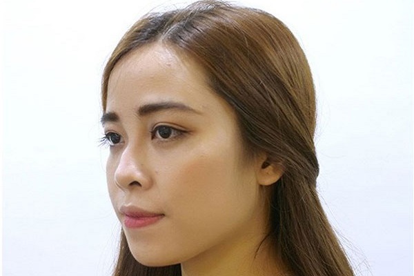 Tướng mũi gãy ở đàn ông, phụ nữ nói lên điều gì?-3